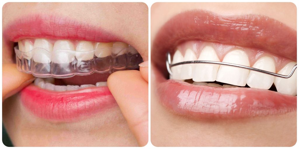 có phải đeo hàm duy trì cả đời không