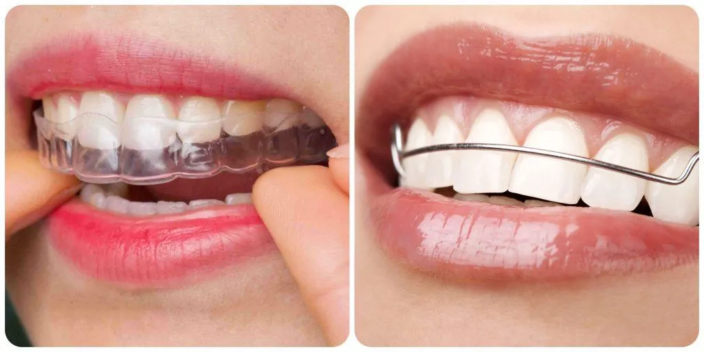 có phải đeo hàm duy trì cả đời không