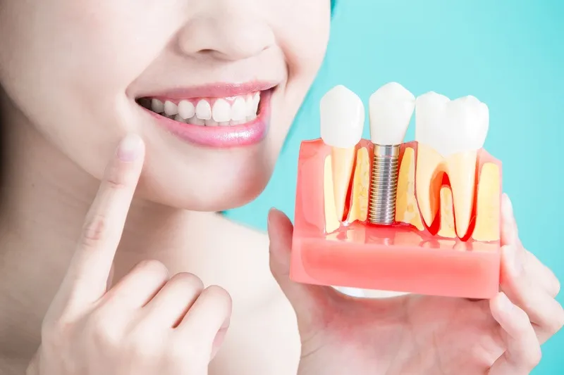 Các yếu tố ảnh hưởng độ bền của răng implant