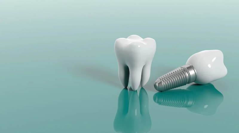 Giá trồng răng implant tại Cẩm Phả