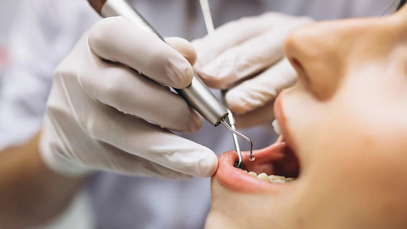 Quy trình nhổ 8 cái răng để niềng