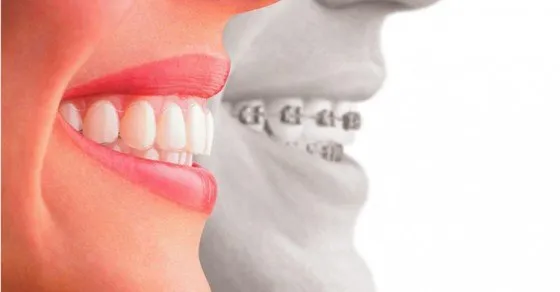 Quy trình điều trị răng hô