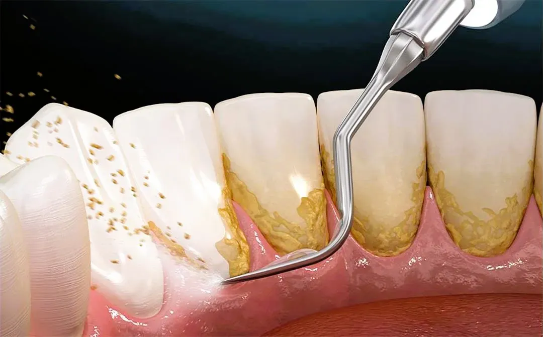 nên lấy cao răng vào lúc nào