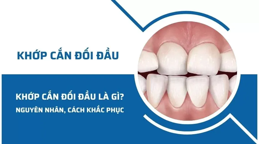 khớp cắn đối đầu