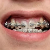 khớp cắn ngược