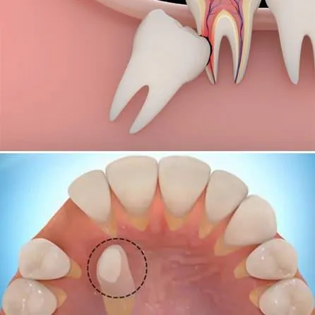 dấu hiệu răng mọc ngầm