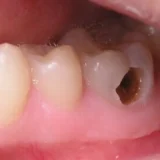 răng số 8 bị sâu có nên nhổ không