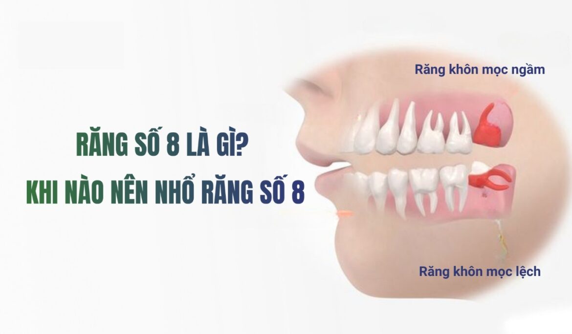 răng số 8 có nên nhổ không