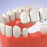 bắc cầu răng