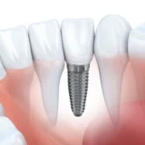 trồng răng giả có đau không