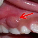 áp xe răng có nguy hiểm không