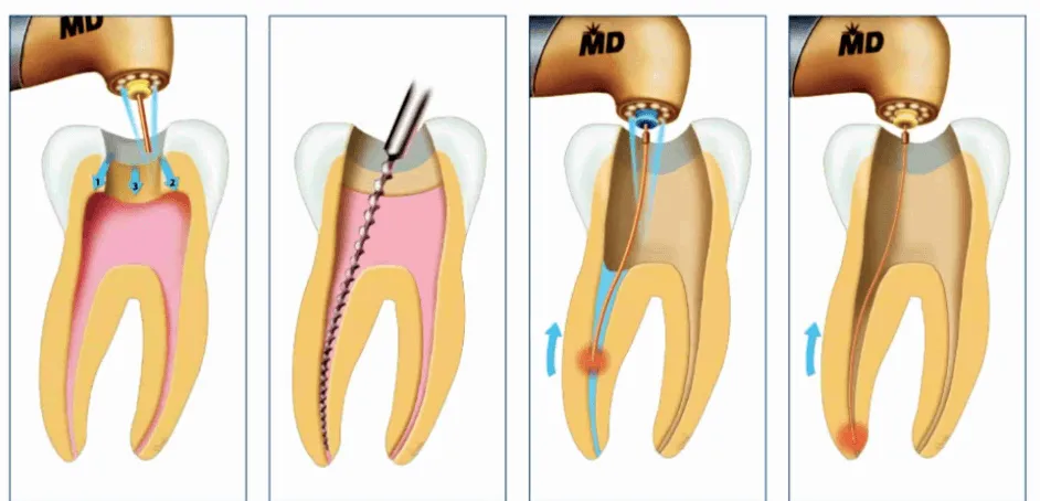 điều trị tủy răng