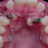 kéo răng mọc ngầm