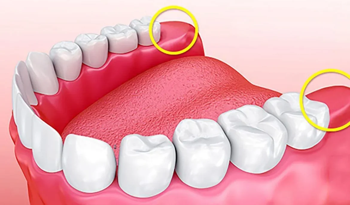 có người không mọc răng khôn