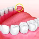 có người không mọc răng khôn