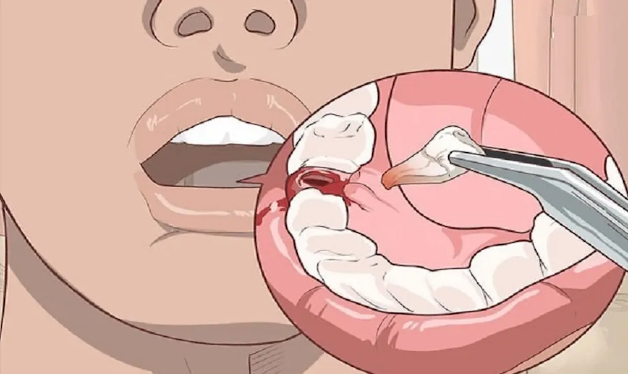 nhổ răng xong lợi có đầy lên không