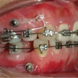 mất răng hàm có niềng răng được không