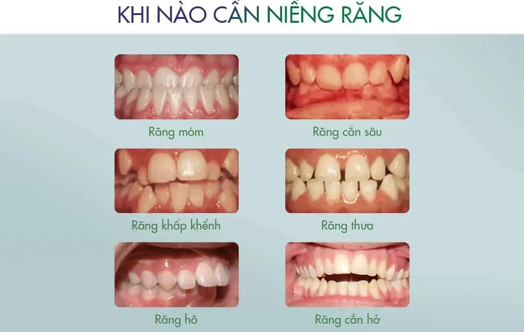 các trường hợp niềng răng